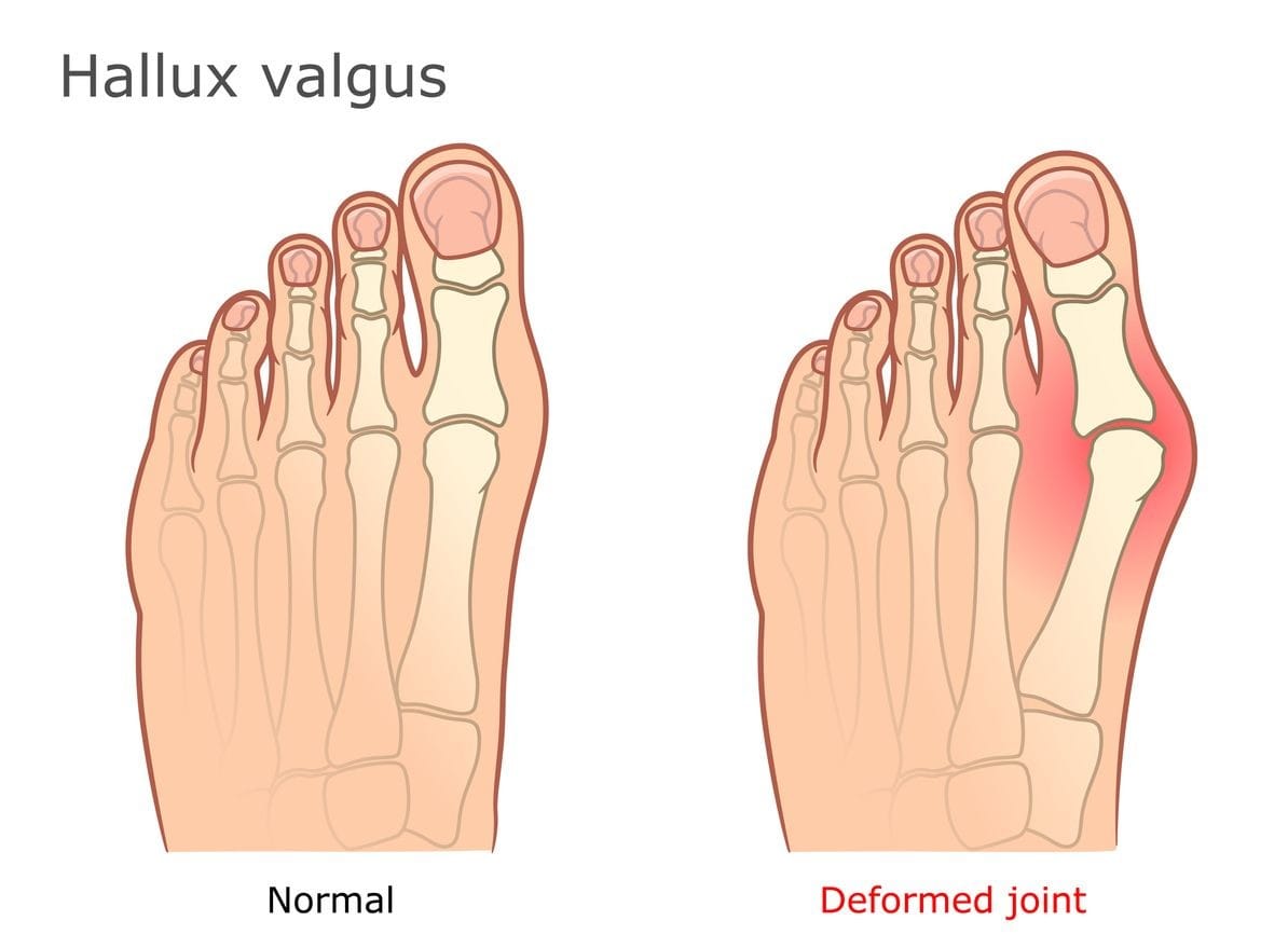 A bunion is a deformed joint at the big toe. Clermont and Leesburg Florida
